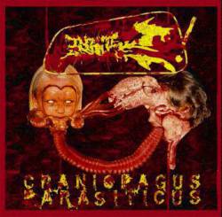 Craniopagus Parasiticus